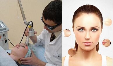 كيف تتم عملية تجديد سطح الجلد بالليزر؟